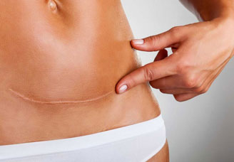 Cirurgia reparadora de cicatrizes